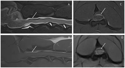 Case report: Intracranial and spinal subarachnoid hemorrhage in a dog with Angiostrongylosis